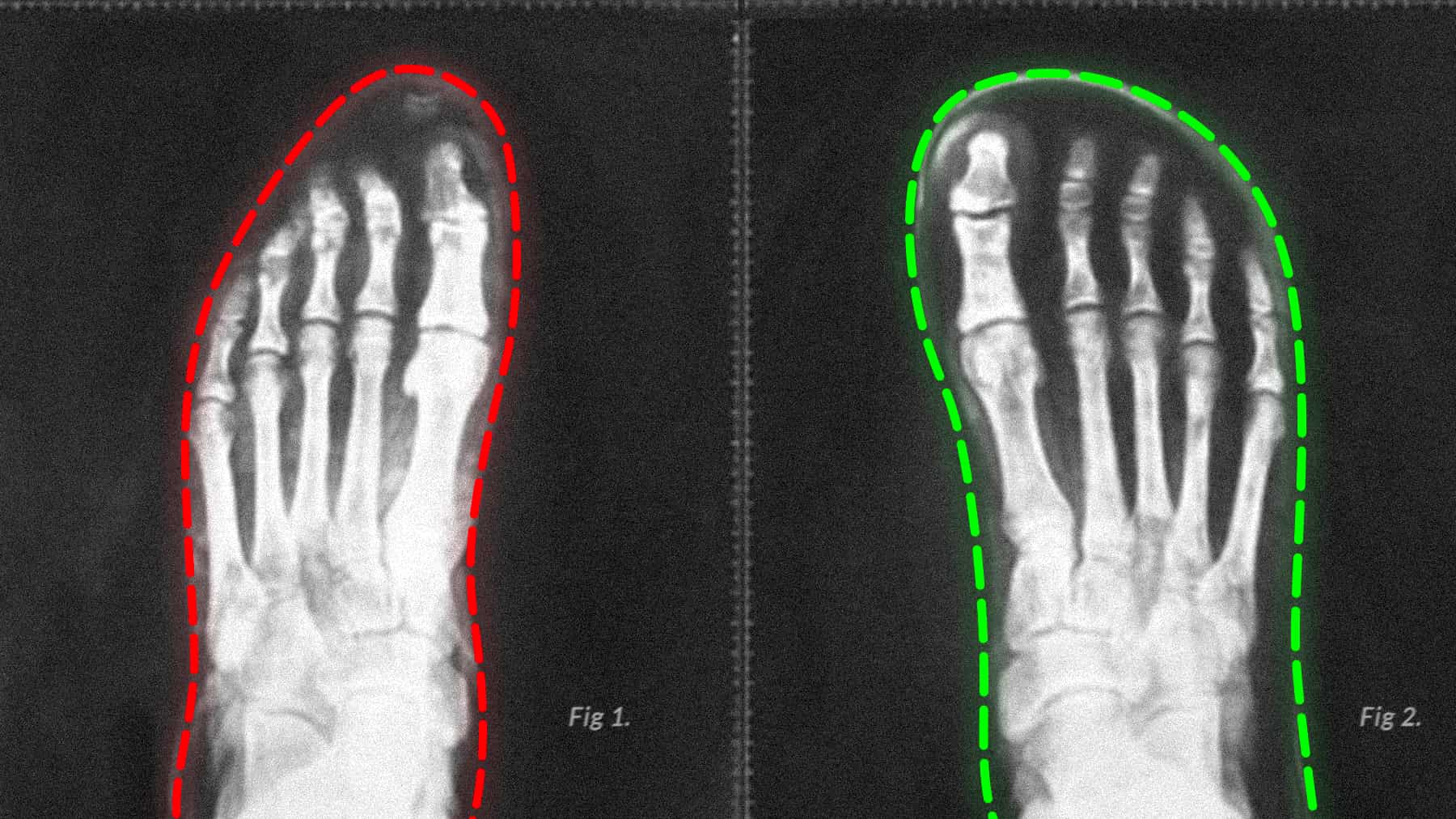 Image illustrating the difference is foot shape with modern footwear on the left versus barefoot style footwear on the right